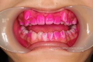 歯垢染色液（赤染め） | 池袋大松矯正歯科クリニック